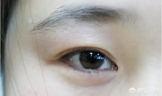上眼皮松弛怎么办(上眼皮太松有什么办法改善)
