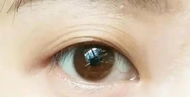 下眼睑老化有哪些表现?眼部肌肤老化如何改善,你需要知道