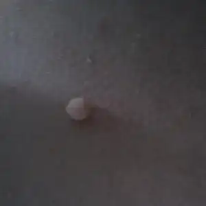 胸口长得一个小肉瘤,请问是什么东西?怎么治疗?