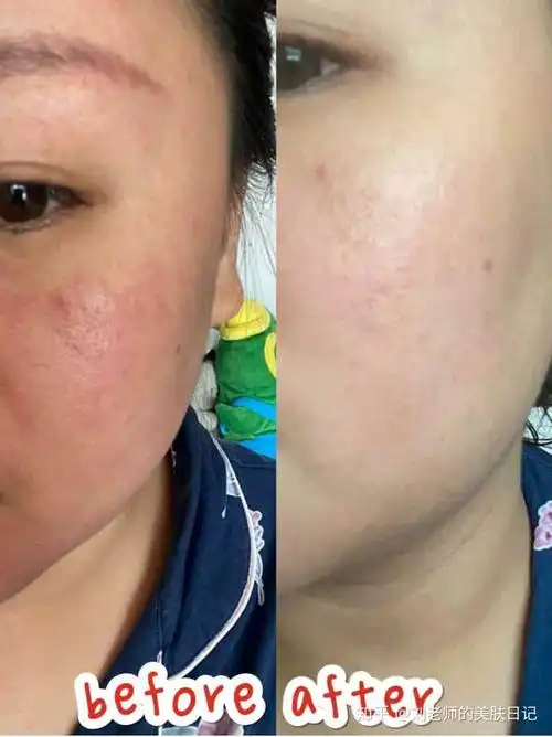 是皮肤屏障受损,角质层变薄,应注意护肤品用医用的,修负皮肤屏障,增厚