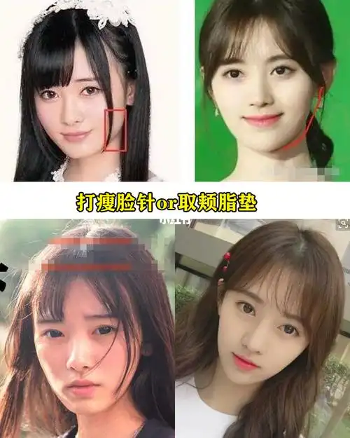 扒一扒鞠婧祎的变美小心机7515_脸型_颧骨_鞠婧祎_发际线_瘦脸针