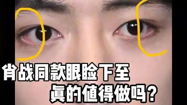 肖战同款眼睑下至,真的值得做吗?-美妆视频-搜狐视频