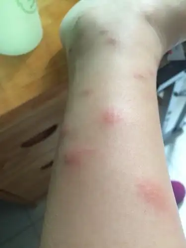 身上开始长这样的痘痘,又痒又红感觉不是蚊子咬的,这是啥痘痘怎么办啊