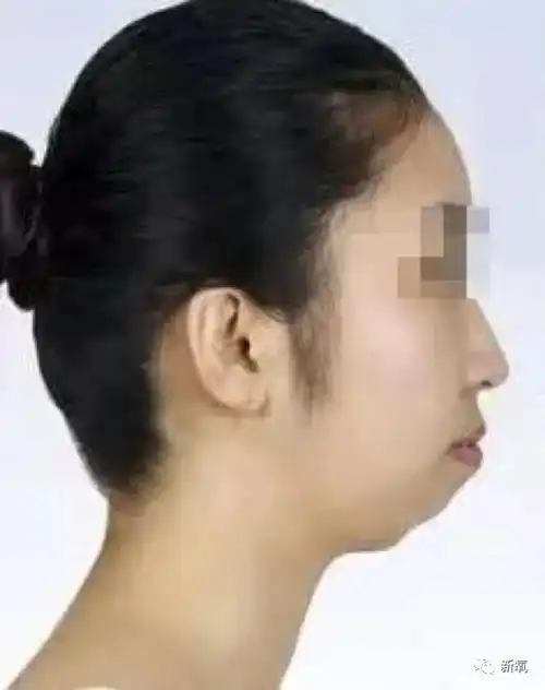 关晓彤和张嘉倪侧颜对决,被摁在地上摩擦啊…|金喜爱|下颌|颈阔肌