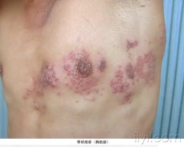 常见皮肤病图谱