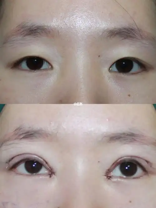 昆明全切双眼皮77开眼角即刻效果_开眼角_全切双眼皮_双眼皮手术_双