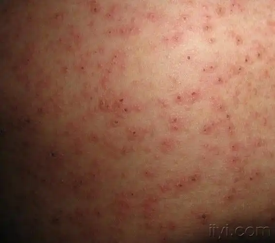 这是什么病疥疮吗