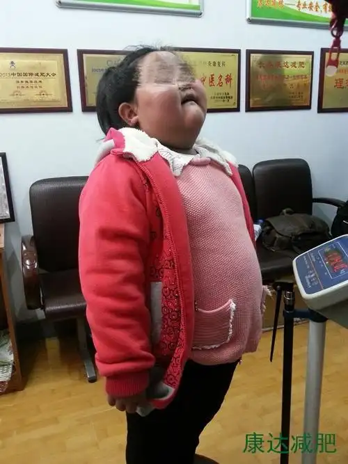 此外,过胖的男孩通常性腺发育不良,因为脂肪对雄性激素的代谢有一些