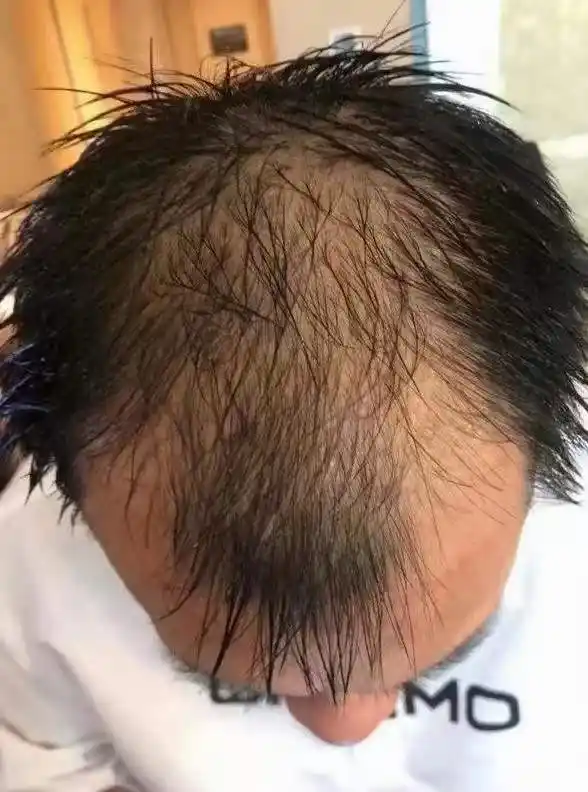 男性m型脱发,药物治疗有用吗?