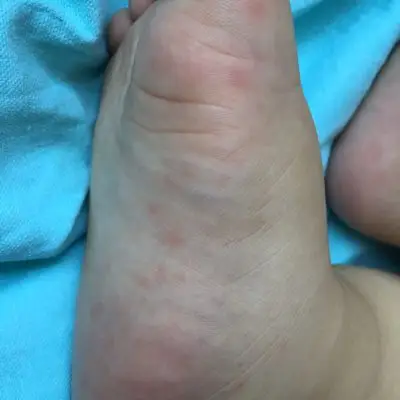 请问这是手足口病吗?屁股上也有,手心裏有两个小红点