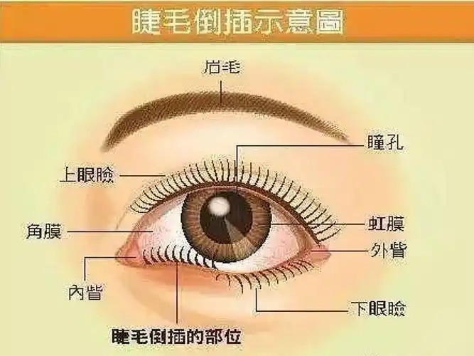 兰宇科普小课堂眼睑倒睫