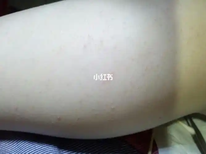 请问一下,小孩子的小腿内侧这到底长的是毛囊炎还是鸡皮疙瘩?