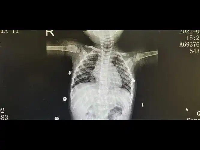 胸片可见两肺弥漫炎性渗出影,因此诊断为小儿支气管肺炎