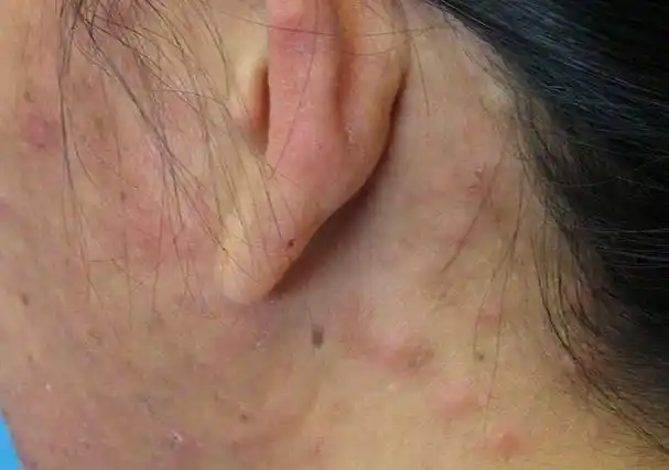 人工寻麻疹是艾滋病的初期症状吗_艾滋病初期_艾滋病感染一般初期会有