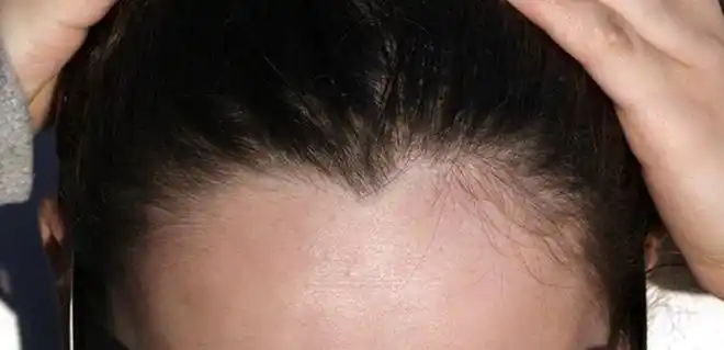 美人尖是发际线的一种异常现象,是由于额头上的双侧毛发生长抑制区的