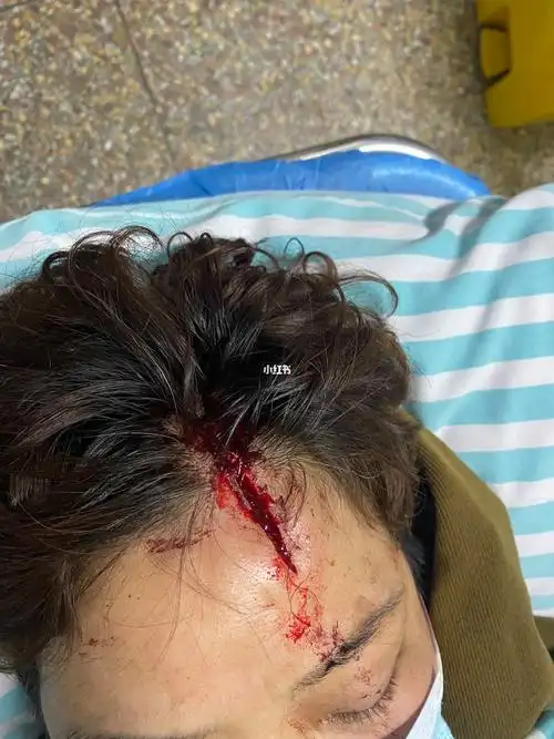 目前已经住院,头上缝针了,做过ct,下午去做磁共振,因为我妈一直叫关节