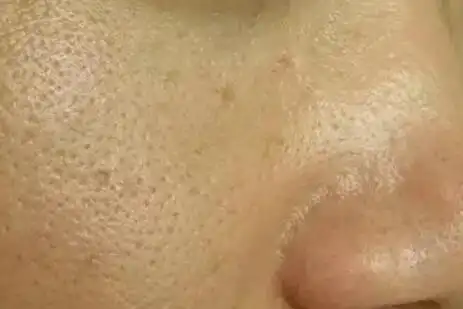 毛孔粗大怎么破