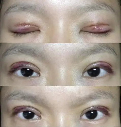 埋线双眼皮一周效果图