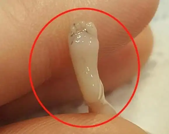 女子怀孕14周流产胎儿模样曝光引发网友接连高喊对不起