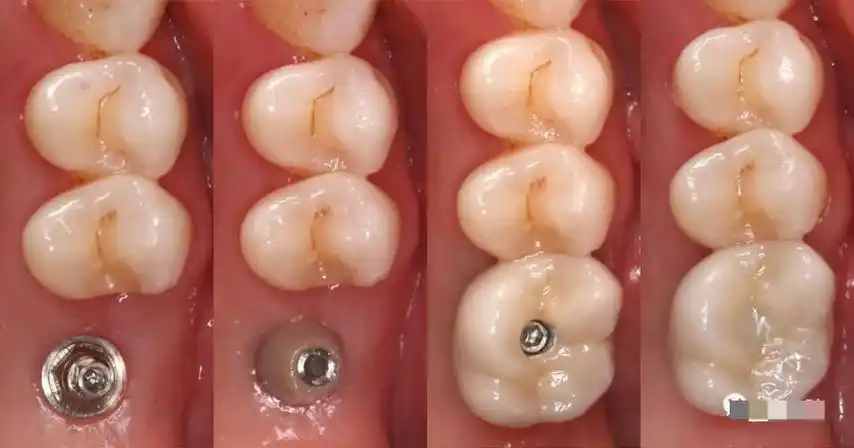 种植牙修复过程中常出现的并发症及其处理_医学界-助力医生临床决策和