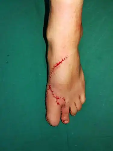 左足修复后外形,五根脚趾一根都不少!