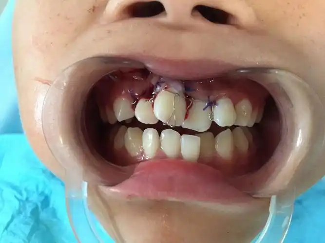 右上中切牙埋伏阻生移植