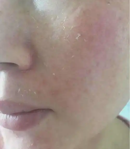 颜值小院i角质层薄该怎么修复