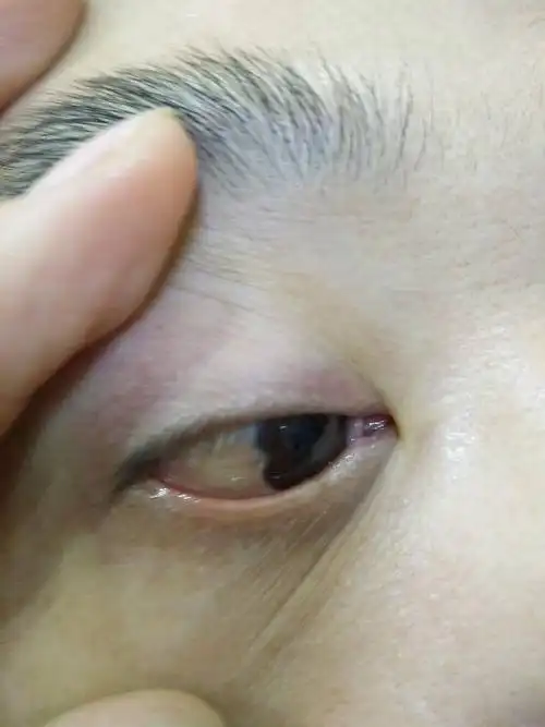 眼睛长东西了,请问是什么,应该咋处理,谢谢