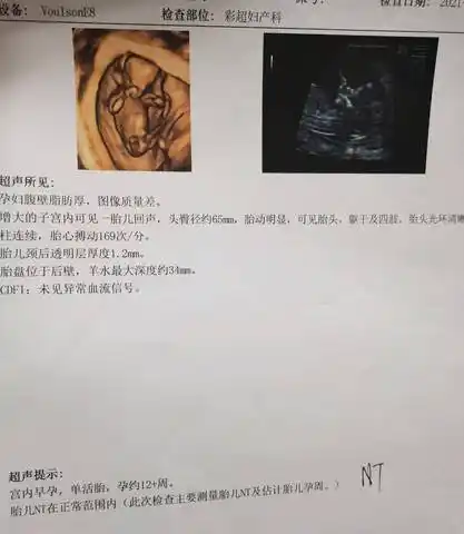 刚做完nt 中间那个是脐带嘛,大家可以看出是男宝还是女宝嘛