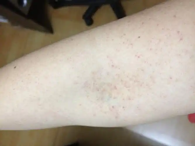 5 皮肤一痒一挠就这么多红血点,平时挠哪里就哪里有红点,我记得我只挠