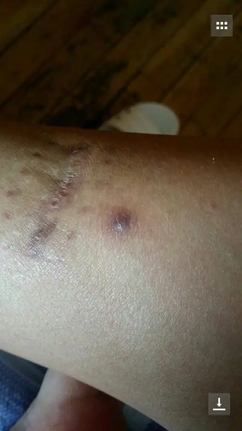 腿上长了一个红色软包