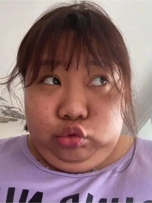 我终于知道为啥越胖越长痘了