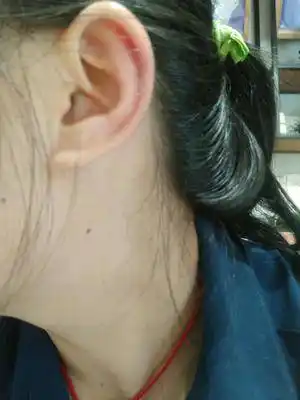 有耳朵这样脱皮发热的