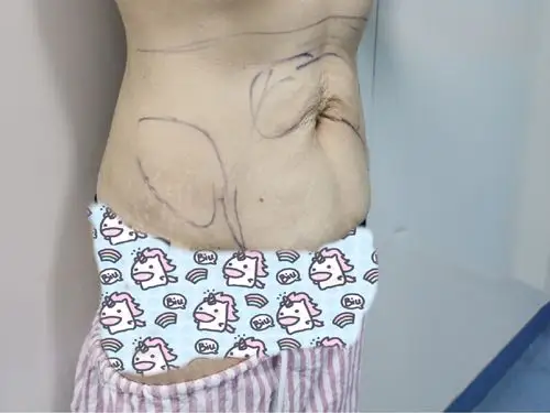 【人鱼体雕腰腹吸脂塑形】