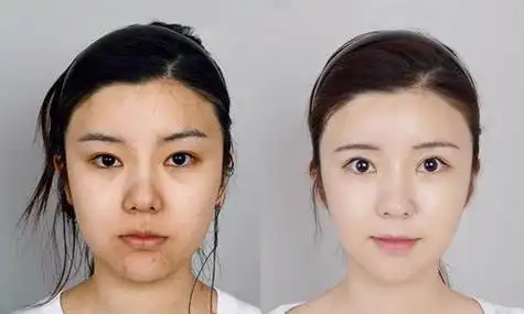 看看真人美白针对比图,你还相信美白针没有效果吗?