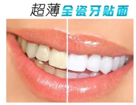 牙齿美白的技巧—瓷贴面_牙龈