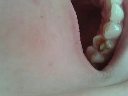 上牙左侧第一前磨牙外面的一半整个烂掉,反正不痛不痒一点事儿没有