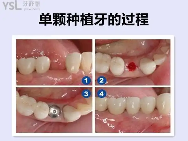 网友1388758提问想知道北京种植牙多少钱一颗2021价格表会越来越贵吗
