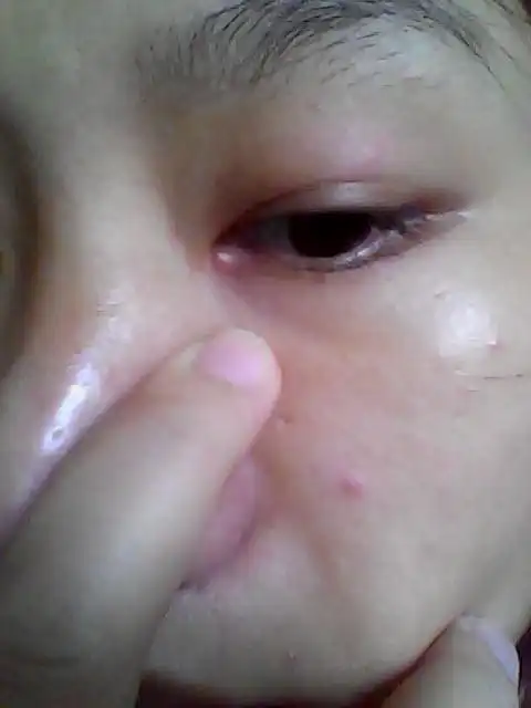 问:眼睛长了这个东西,不知道算不算麦粒肿?如图