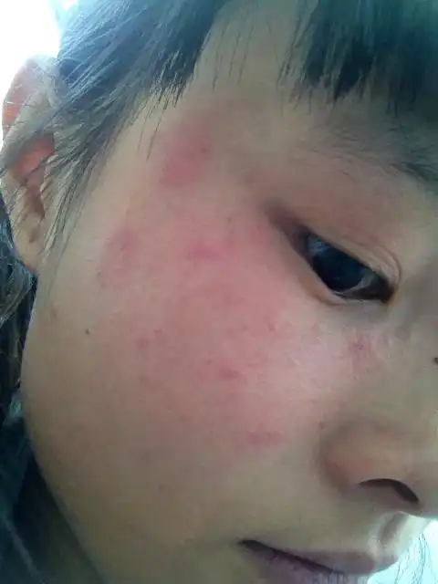 我面部皮肤过敏已经有6天了,也吃了6天的