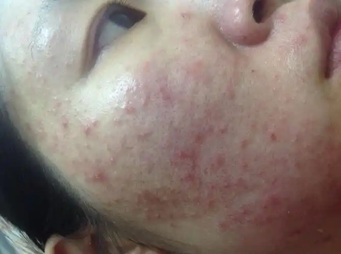 问:最近快毁容了 ,这皮肤是怎么了啊 脸痘痘疙瘩 早上起床好点.