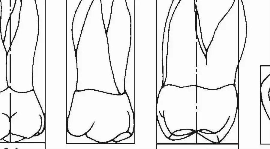 图3-10 上颌磨牙图3-11 下颌磨牙图3-12 下颌第一磨牙指向颊侧的沟状