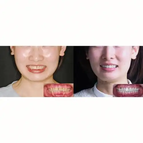 这是二次矫正病例,第一次的矫正已经拔除四颗双尖牙,但前牙内收不理想