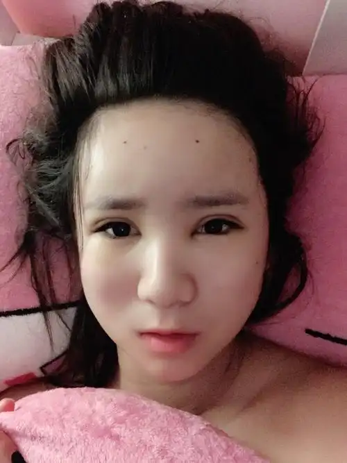 我面部脂肪填充第五天苹果肌两侧有硬块特别明显然后整个脸肿的往下垂