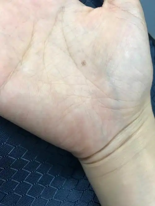 小时候手掌长了个痣,很多年了,请问有没有人知道这个有发展为黑色素瘤