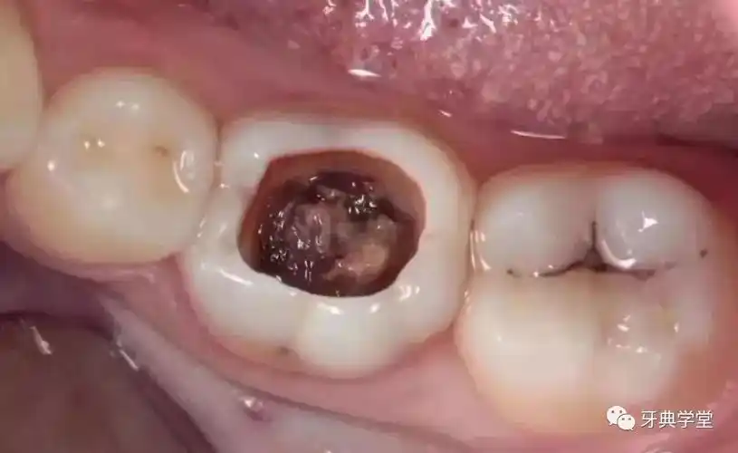 从【蛀牙】到【拔牙】,看看牙齿是怎么下岗的?