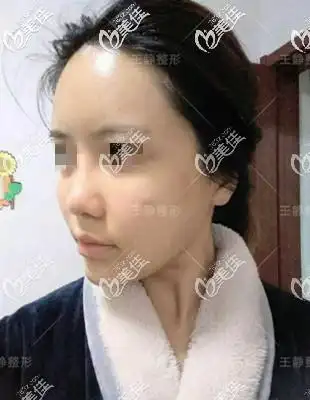 不私藏自体脂肪填充全脸没变成很假的大饼脸恢复自然的照片大公开