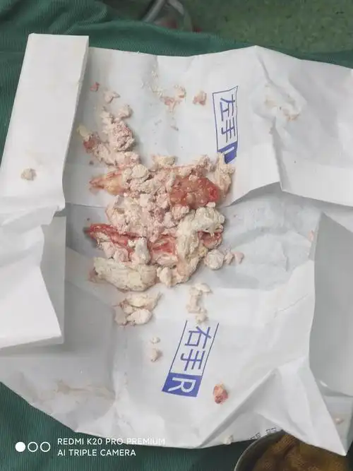 手术中取出尿酸结晶体.