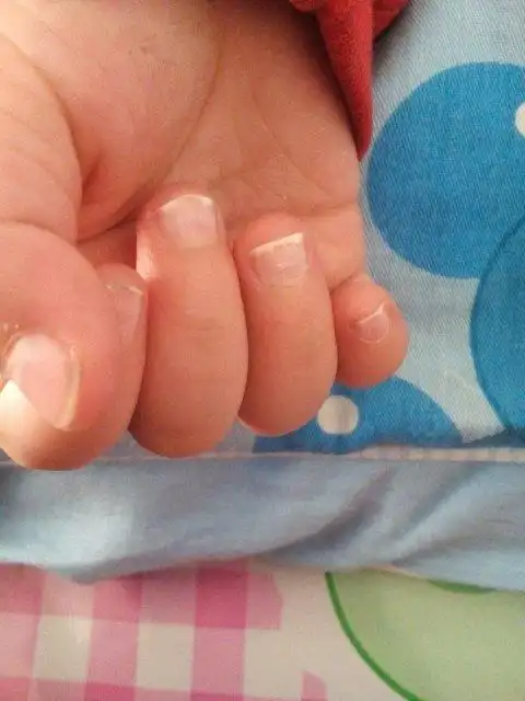 十四个月宝宝 手指甲白色东西是怎么回事