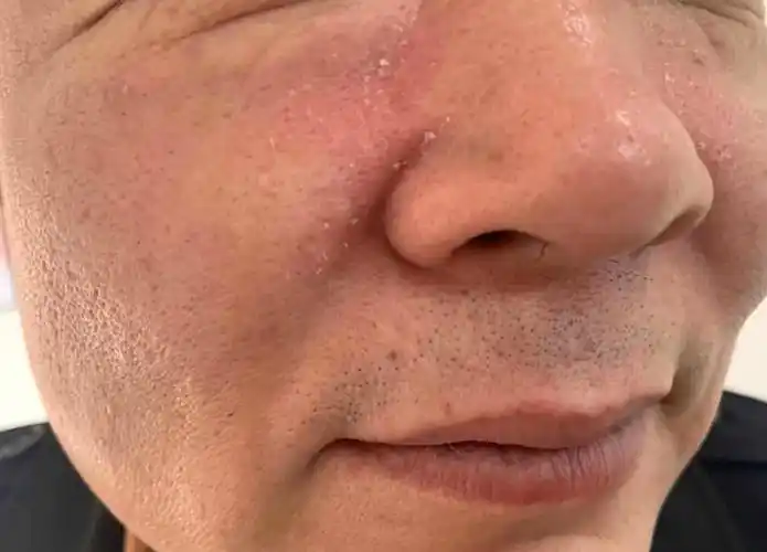 脂溢性皮炎的三个关键点